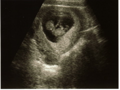 1st Ultrasound - 1