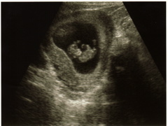1st Ultrasound - 2