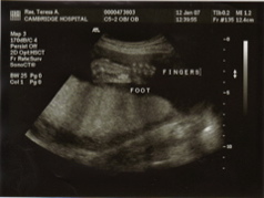 1st Ultrasound - 2